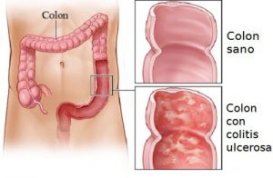 ¿Cómo se produce la colitis ulcerosa?